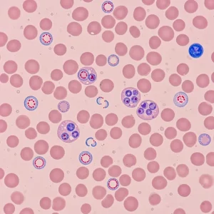 Malarial Smear